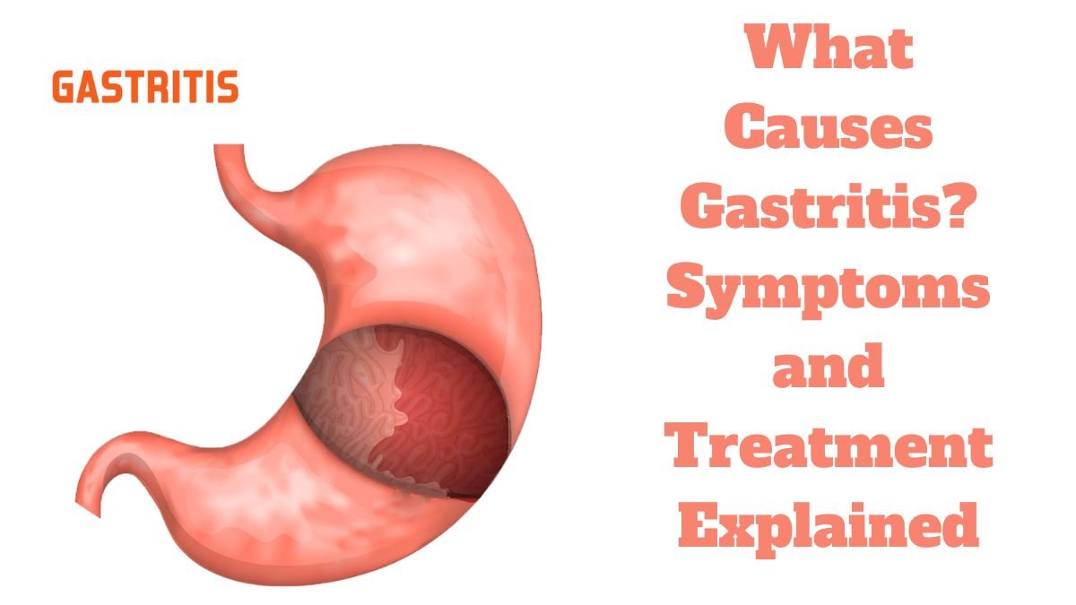What Causes Gastritis Symptoms and Treatment Explained (2)